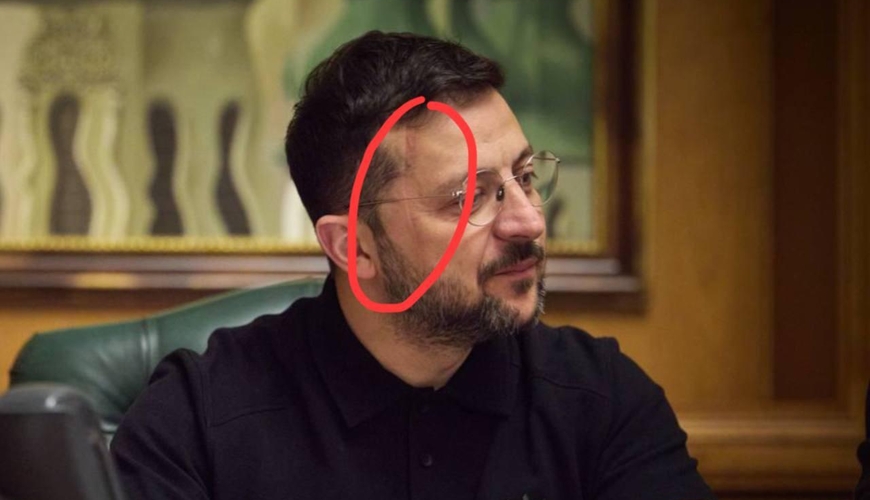 Zelenskinin üzünə nə olub? - FOTO