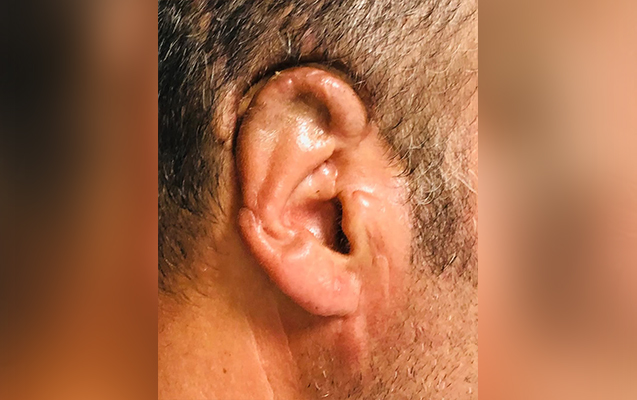 Qopan qulağı 34 saat sonra yerinə tikildi - Foto